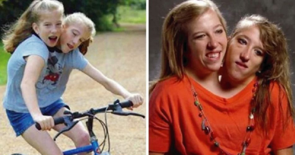 Gemelle Siamesi prima e dopo, l'incredibile storia di Abby e Brittany