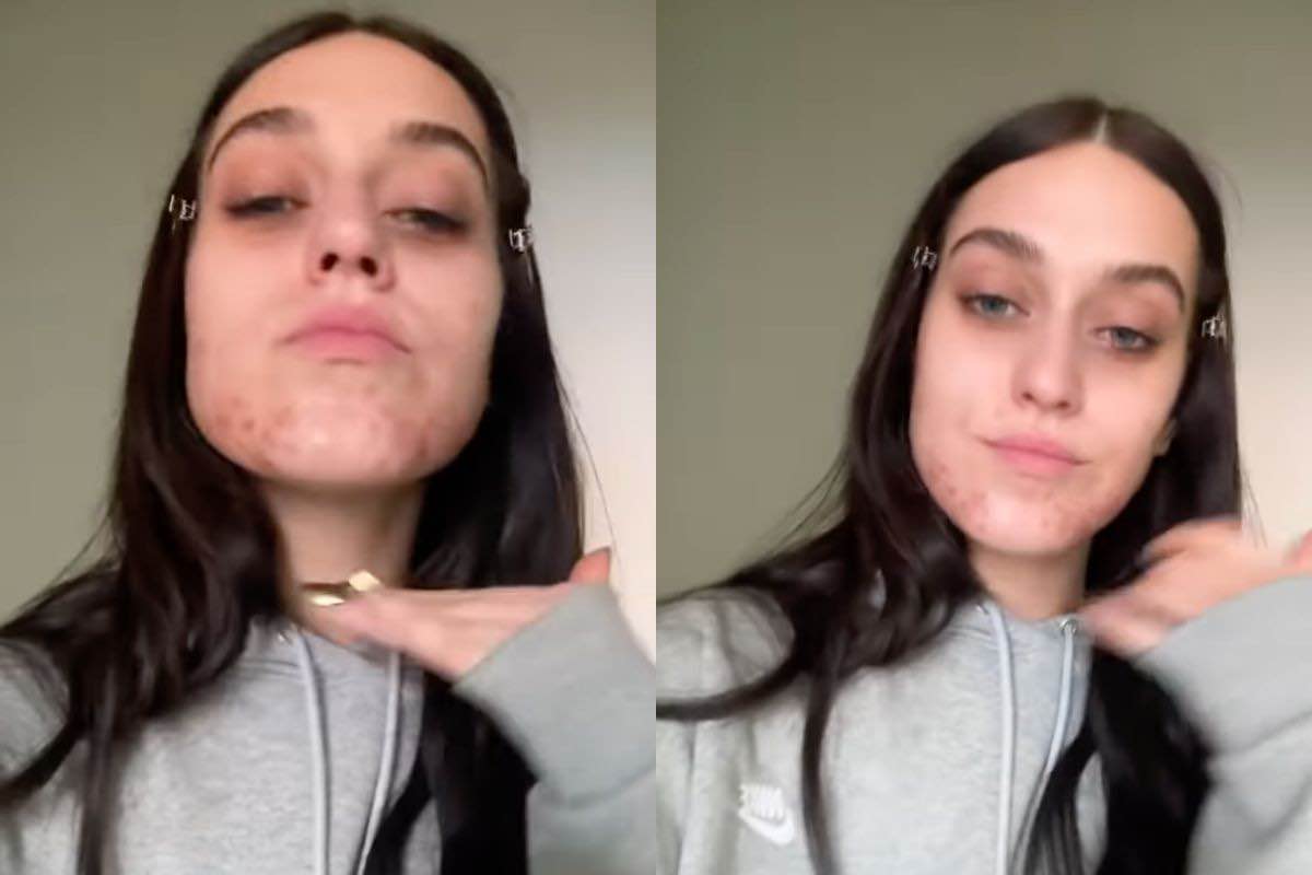 gaia mostra l'acne sui social